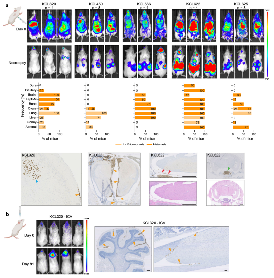 Nature子刊：患者來源的類器官，為乳腺癌腦轉移帶來新見解